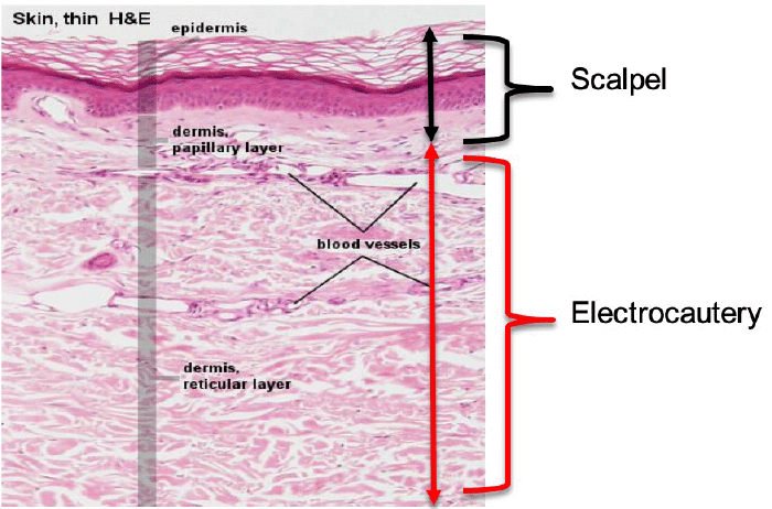 A Better Incision: The Best of Both Worlds | ACS