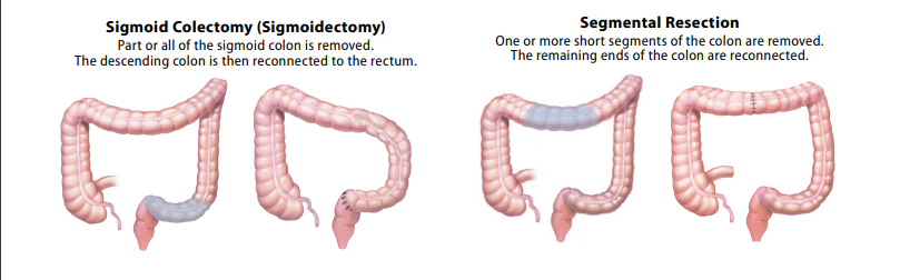 Colectomy | ACS