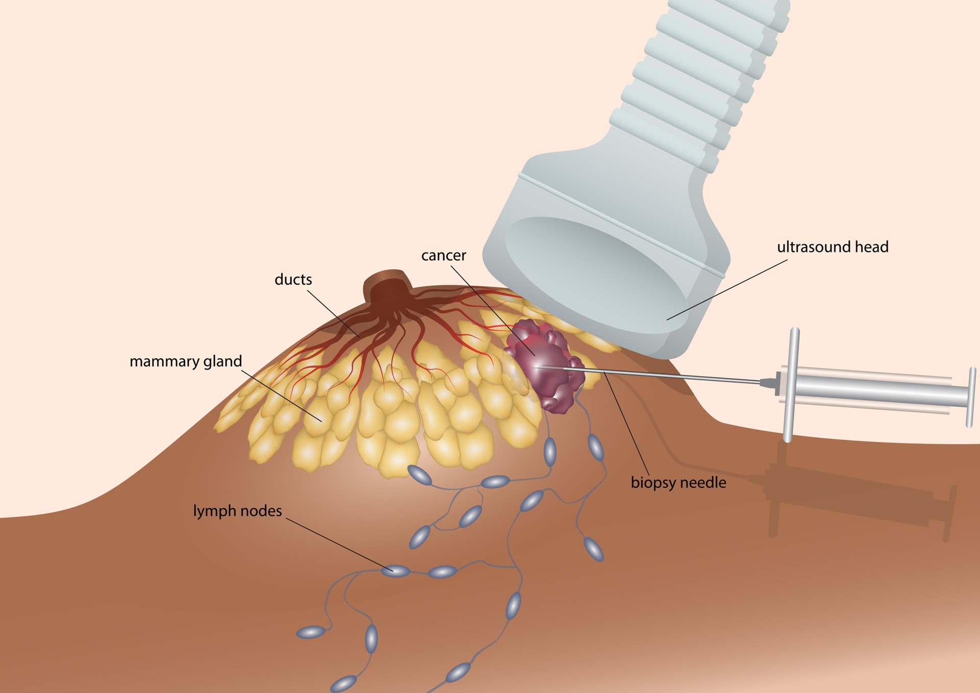 Biopsy ACS