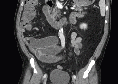 Small Bowel Obstruction Due to NSAID-Induced Jejunal Enteropathy | ACS