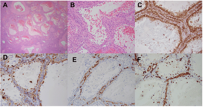 Littoral Cell Angioma Presenting as an Atraumatic Splenic Rupture in a ...